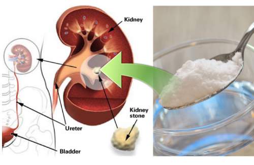 How-To-Repair-Your-Damaged-Kidney-With-Only-1-Teaspoon-Of-Baking-Soda