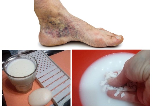 magical-recipe-for-varicose-veins-and-thrombosis-with-only-2-simple-ingredients-1