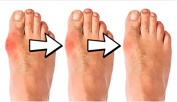 natural-remedies-for-bunions__1441926716_8.12.1.98