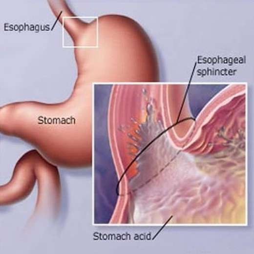 gastritis