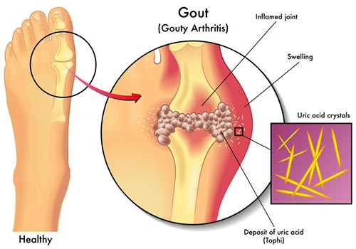 Gout-Treatment-Specialist-NYC