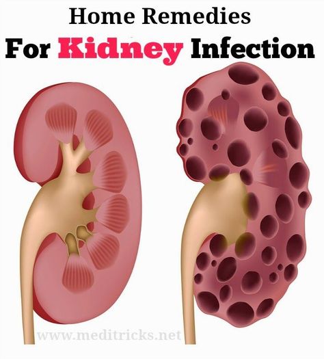 kidney-infection-remedies