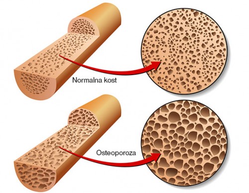 Естествена превенция на остеопорозата
