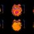 Лекарство за често срещано заболяване вероятно забавя напредването на болестта на Алцхаймер